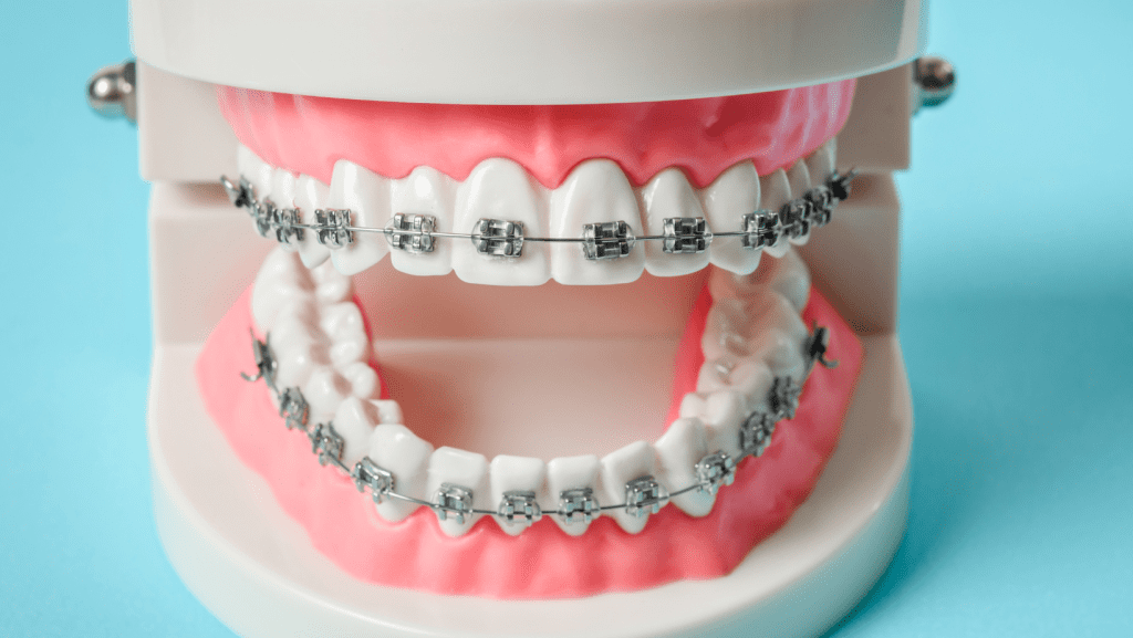 Unlock Your Smile Top 7 SA Medical Aids Now Covering Braces In 2023 unlock-your-smile-top-7-sa-medical-aids-now-covering-braces-in-2023