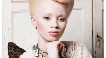 South Africa Unites: Justice for Albinism against Discrimination